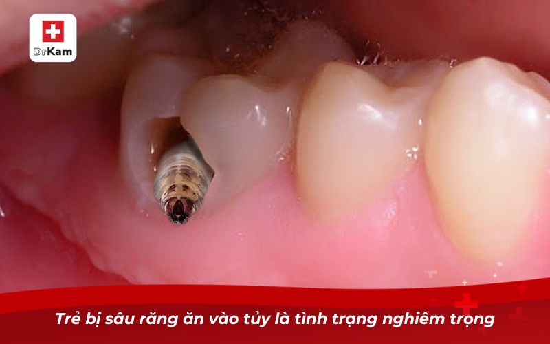 Trẻ bị sâu răng ăn vào tủy có nguy hiểm không? 7 Trẻ bị sâu răng ăn vào tủy là tình trạng nghiêm trọng