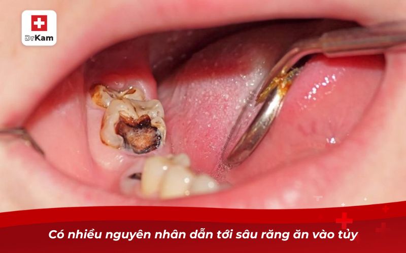 Trẻ bị sâu răng ăn vào tủy có nguy hiểm không? 8 Có nhiều nguyên nhân dẫn tới sâu răng ăn vào tủy