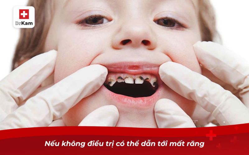 Trẻ bị sâu răng ăn vào tủy có nguy hiểm không? 9 Nếu không điều trị có thể dẫn tới mất răng