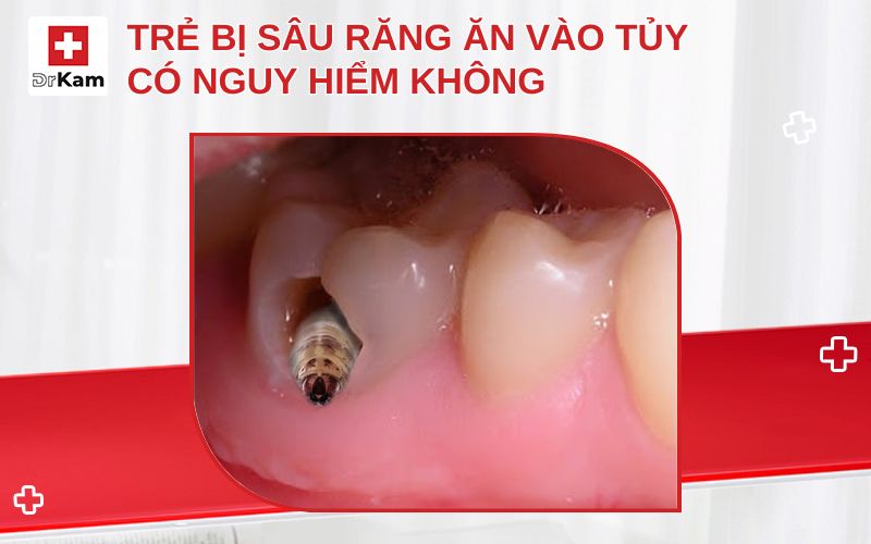 tre bi sau rang an vao tuy thumbnail