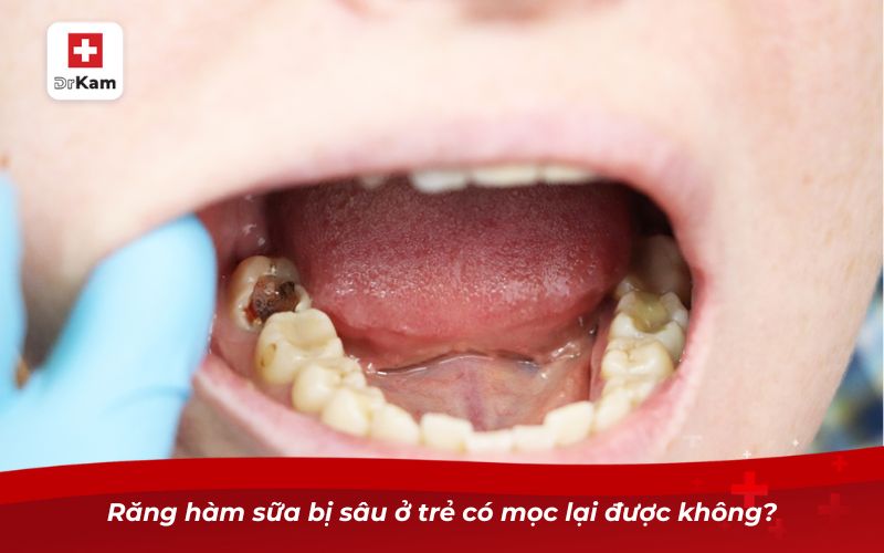 Răng hàm sữa bị sâu ở trẻ có mọc lại được không?