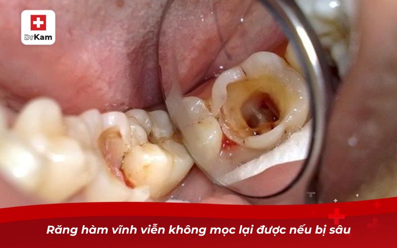 Răng hàm vĩnh viễn không mọc lại được nếu bị sâu