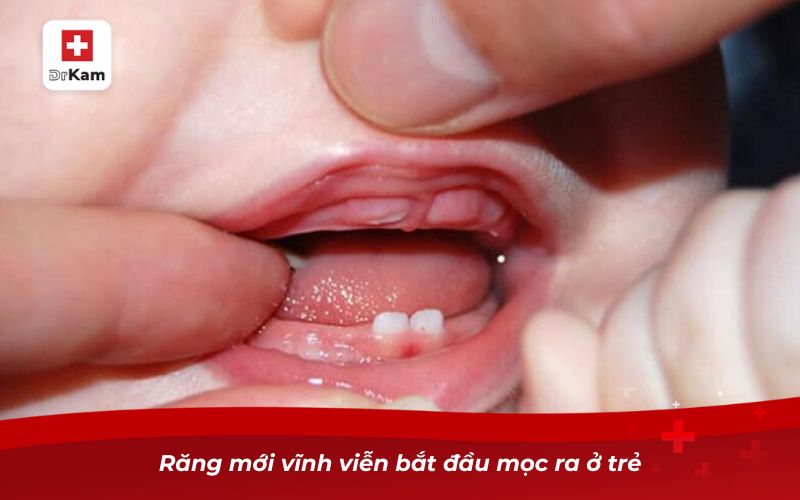 Răng mới vĩnh viễn bắt đầu mọc ra ở trẻ