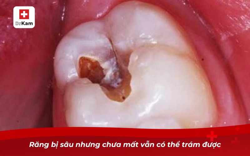 Răng bị sâu nhưng chưa mất vẫn có thể trám được