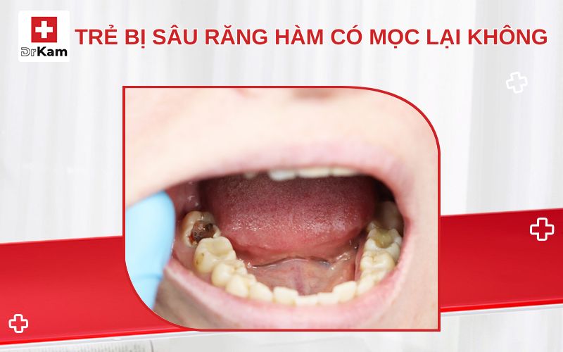tre bi sau rang ham co moc lai khong thumbnail