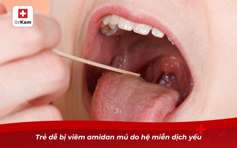 Trẻ dễ bị viêm amidan mủ do hệ miễn dịch yếu