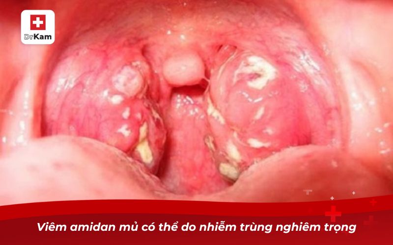 Viêm amidan mủ có thể do nhiễm trùng nghiêm trọng