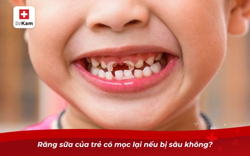 Tìm hiểu về vấn đề trẻ em bị sâu răng có mọc lại không? 6 Răng sữa của trẻ có mọc lại nếu bị sâu không?