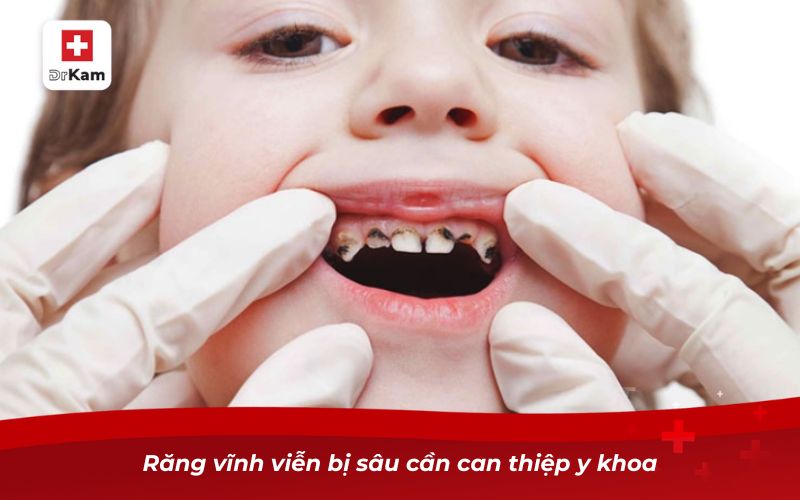Tìm hiểu về vấn đề trẻ em bị sâu răng có mọc lại không? 7 Răng vĩnh viễn bị sâu cần can thiệp y khoa
