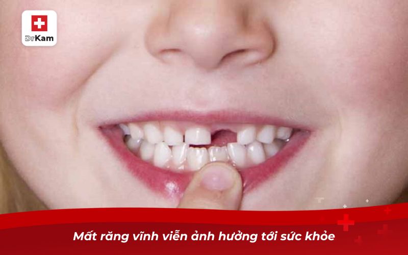 Tìm hiểu về vấn đề trẻ em bị sâu răng có mọc lại không? 9 Mất răng vĩnh viễn ảnh hưởng tới sức khỏe