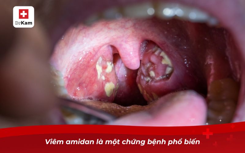 Cách trị viêm amidan tại nhà hiệu quả và đơn giản 8 Viêm amidan là một chứng bệnh phổ biến