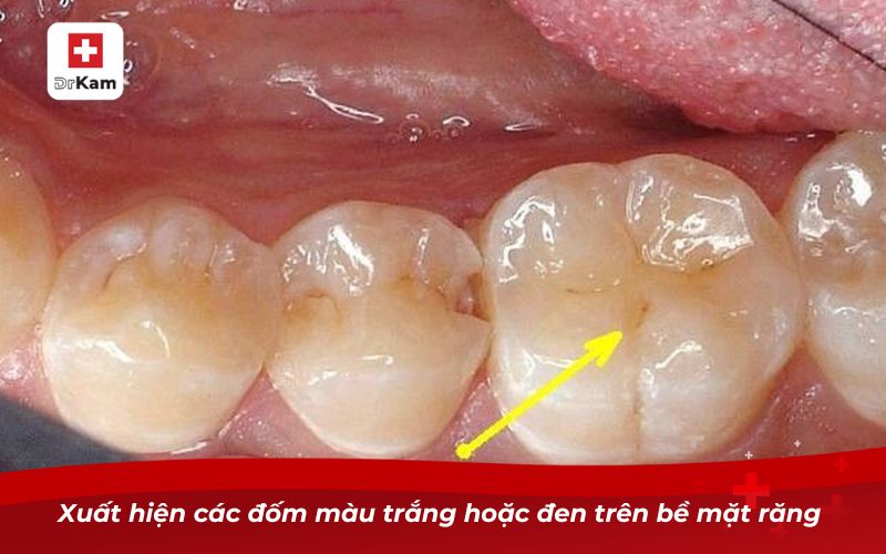 Triệu chứng sâu răng - Dấu hiệu nhận biết và cách xử lý 6 Xuất hiện các đốm màu trắng hoặc đen trên bề mặt răng