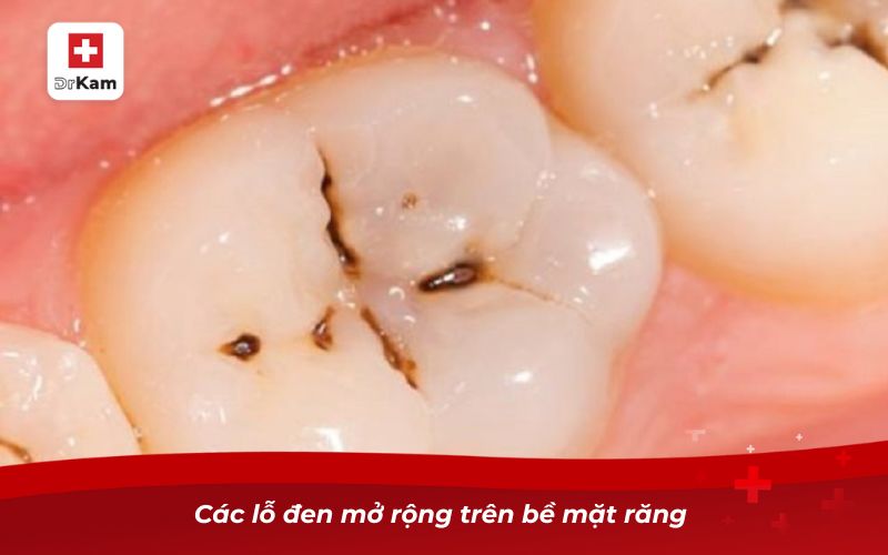 Triệu chứng sâu răng - Dấu hiệu nhận biết và cách xử lý 8 Các lỗ đen mở rộng trên bề mặt răng