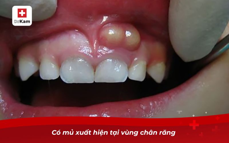 Triệu chứng sâu răng - Dấu hiệu nhận biết và cách xử lý 9 Có mủ xuất hiện tại vùng chân răng