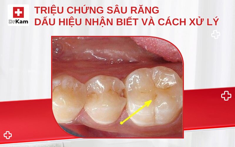 trieu chung sau rang thumbnail
