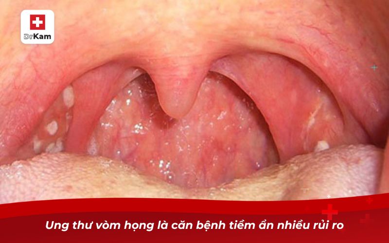 Ung thư vòm họng: Nguyên nhân, triệu chứng và cách phòng ngừa 9 Ung thư vòm họng là căn bệnh tiềm ẩn nhiều rủi ro