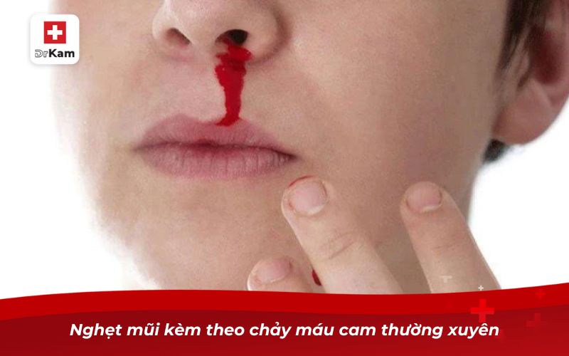 Ung thư vòm họng: Nguyên nhân, triệu chứng và cách phòng ngừa 12 Nghẹt mũi kèm theo chảy máu cam thường xuyên