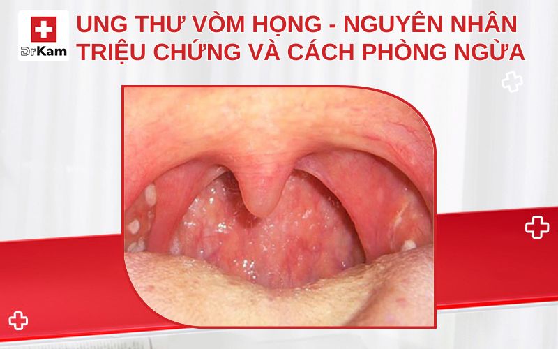 ung thu vom hong thumbnail