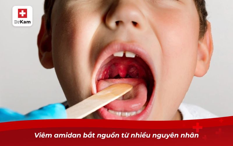 Viêm amidan có lây không và làm sao để tránh nhiễm bệnh? 7 Viêm amidan bắt nguồn từ nhiều nguyên nhân