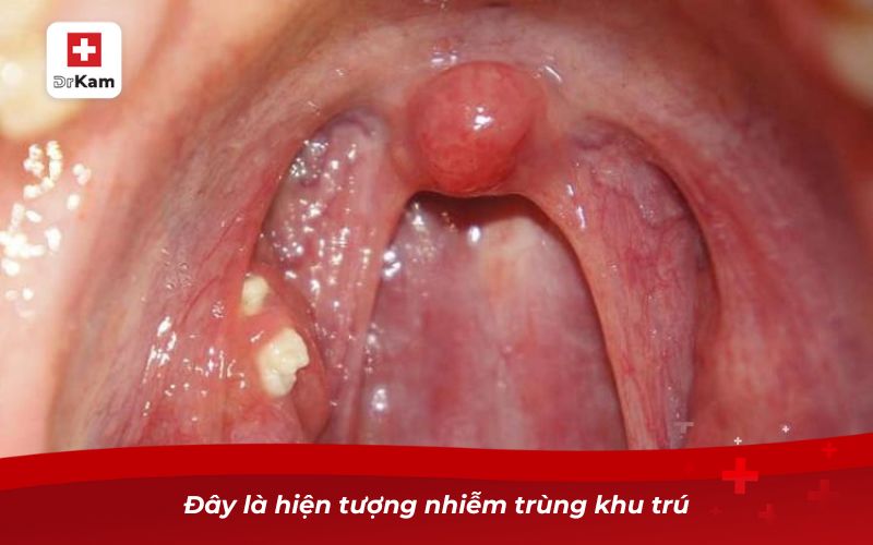 Viêm amidan hốc mủ 1 bên và những điều cần biết 7 Đây là hiện tượng nhiễm trùng khu trú