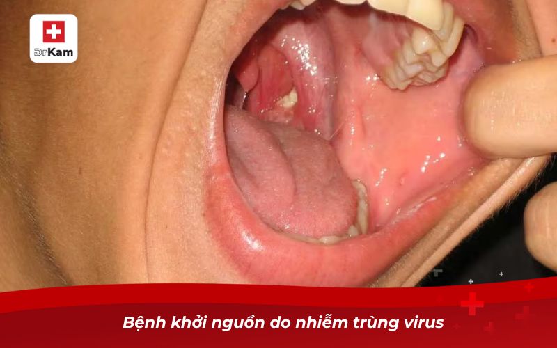 Viêm amidan hốc mủ 1 bên và những điều cần biết 8 Bệnh khởi nguồn do nhiễm trùng virus