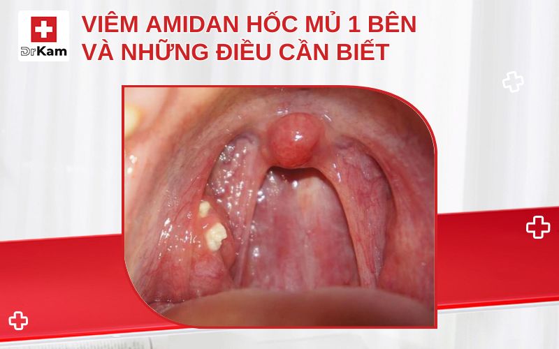 viem amidan hoc mu 1 ben thumbnail