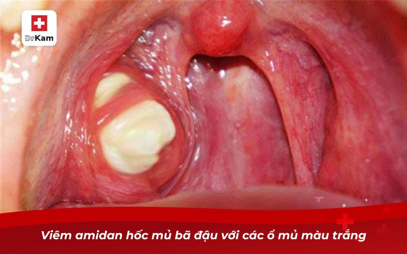Viêm amidan hốc mủ bã đậu với các ổ mủ màu trắng