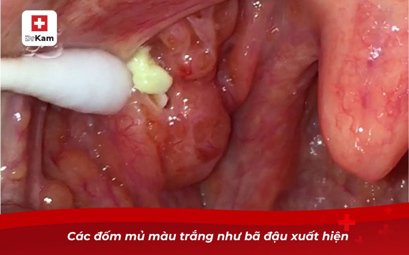 Các đốm mủ màu trắng như bã đậu xuất hiện