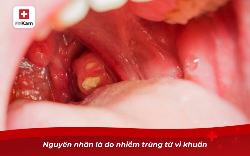 Nguyên nhân là do nhiễm trùng từ vi khuẩn