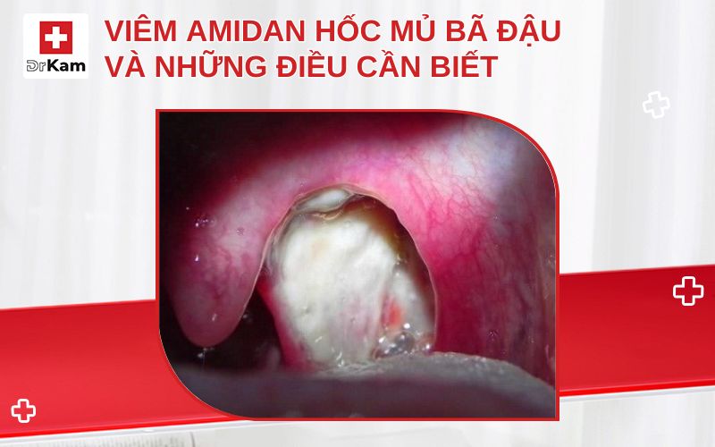 viem amidan hoc mu ba dau thumbnail