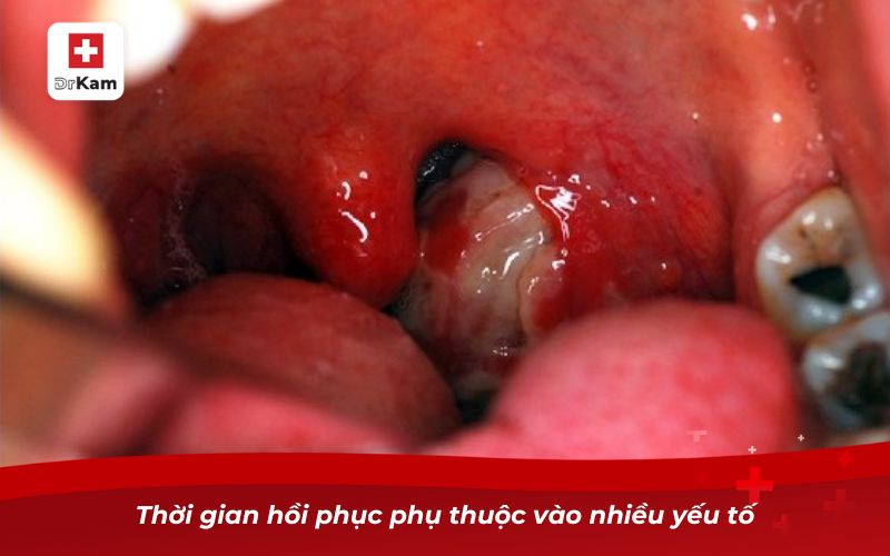 Viêm amidan hốc mủ bao lâu thì khỏi hoàn toàn? 6 Thời gian hồi phục phụ thuộc vào nhiều yếu tố