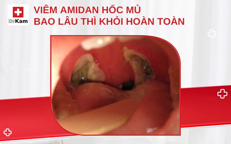 viem amidan hoc mu bao lau thi khoi thumbnail