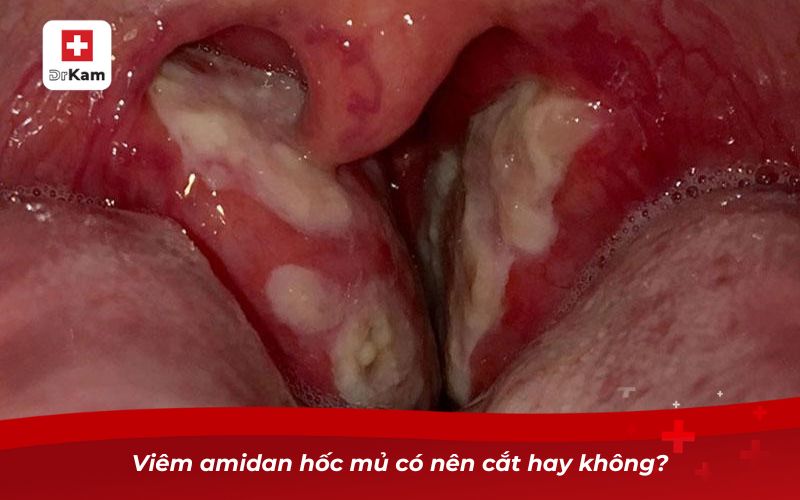 Người Bị Viêm Amidan Hốc Mủ Có Nên Cắt Không? 7 Viêm amidan hốc mủ có nên cắt hay không?