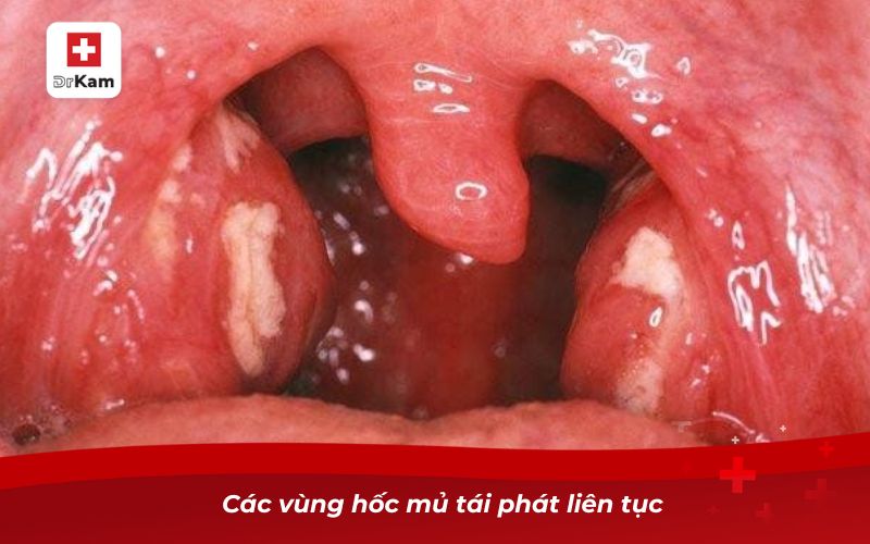 Người Bị Viêm Amidan Hốc Mủ Có Nên Cắt Không? 8 Các vùng hốc mủ tái phát liên tục