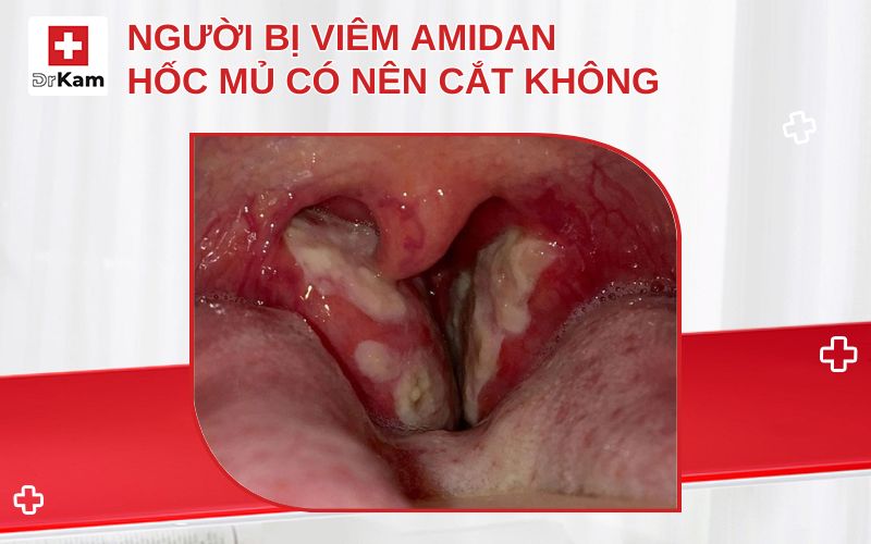 Đây là hiện tượng nhiễm trùng khu trú