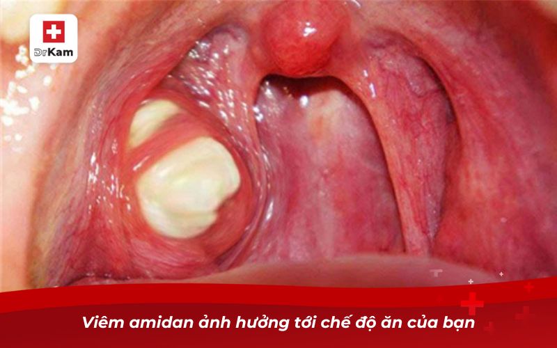 Viêm amidan ảnh hưởng tới chế độ ăn của bạn