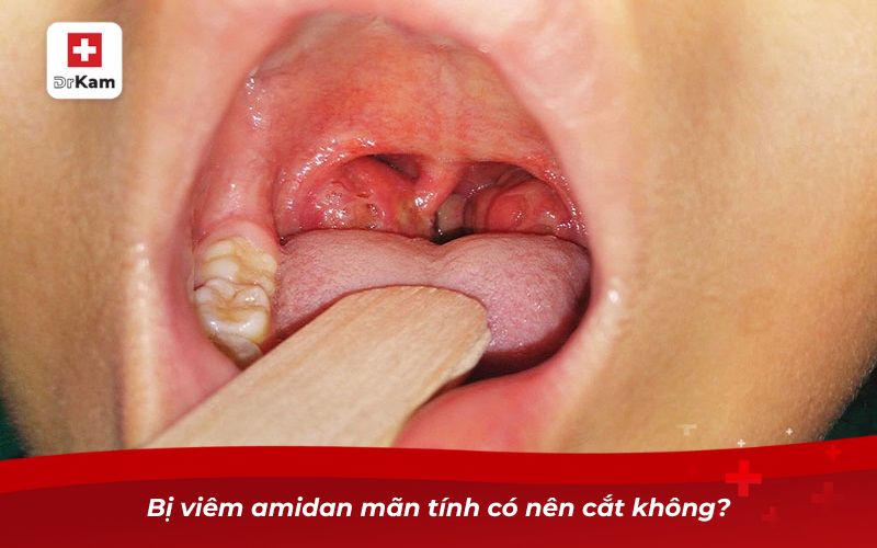 Bị viêm amidan mãn tính có nên cắt không?