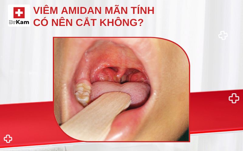 viem amidan man tinh co nen cat khong thumbnail