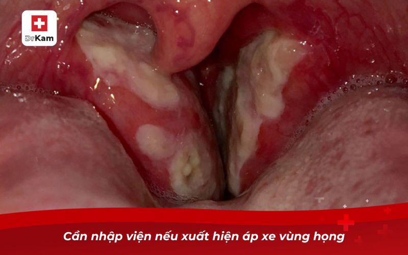 Viêm họng có tự khỏi không? Bí quyết xử lý bệnh hiệu quả 9 Cần nhập viện nếu xuất hiện áp xe vùng họng