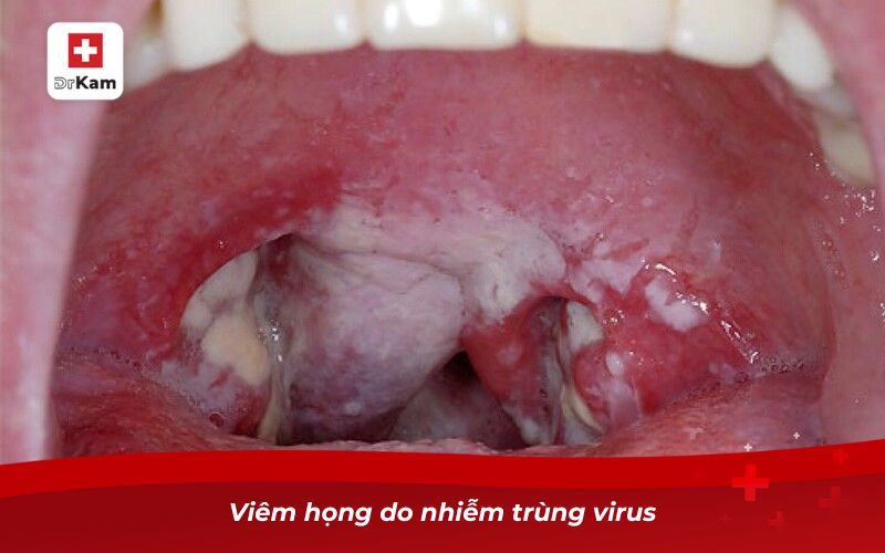 Hướng dẫn nhận biết viêm họng nổi hạch ở cổ 10 Viêm họng do nhiễm trùng virus
