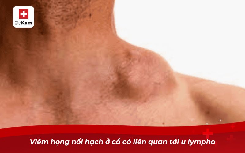 Hướng dẫn nhận biết viêm họng nổi hạch ở cổ 11 Viêm họng nổi hạch ở có liên quan tới u lympho