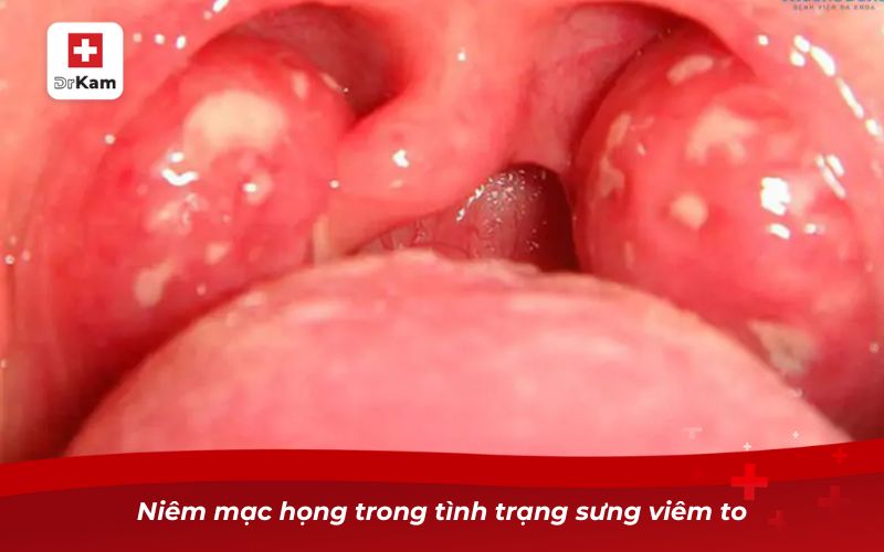 Viêm họng thanh quản cấp và những điều cần biết 10 Niêm mạc họng trong tình trạng sưng viêm to