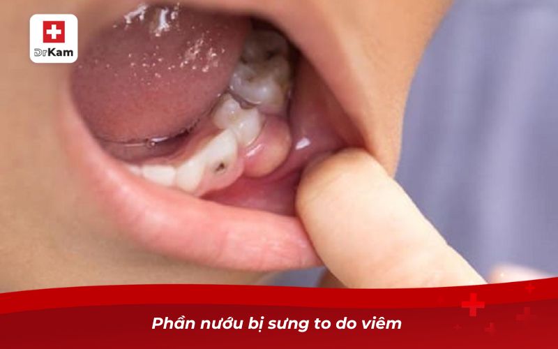 Ăn kẹo bị sâu răng và những điều cần biết 9 Phần nướu bị sưng to do viêm