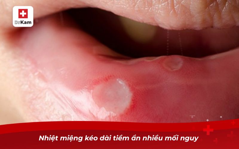 Bị nhiệt miệng thường xuyên phải làm sao? 9 Nhiệt miệng kéo dài tiềm ẩn nhiều mối nguy
