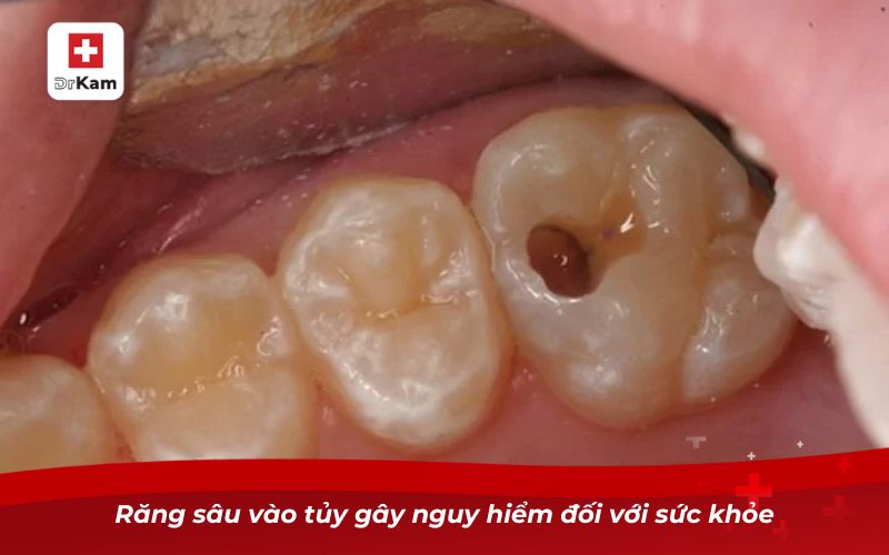 Răng sâu vào tủy gây nguy hiểm đối với sức khỏe