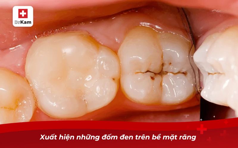 Xuất hiện những đốm đen trên bề mặt răng 