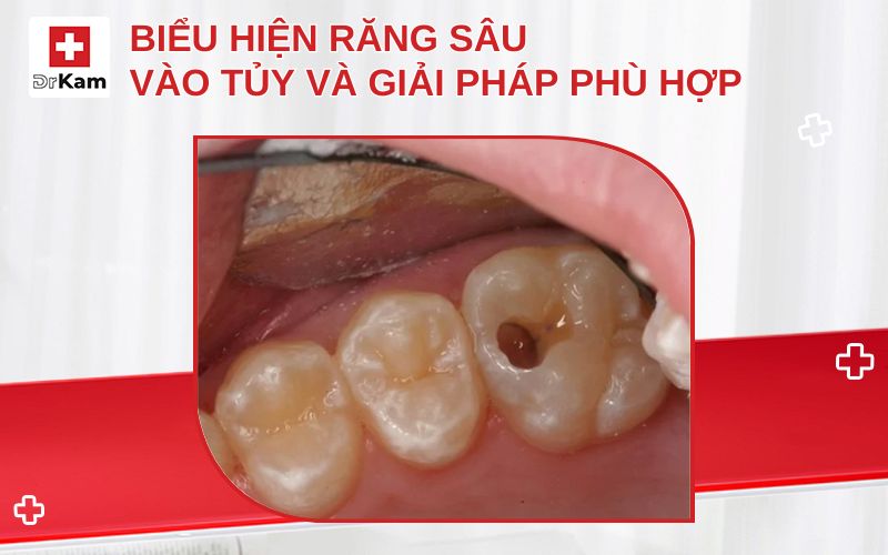 bieu hien rang sau vao tuy thumbnail