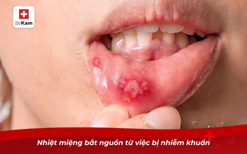 Hướng dẫn cách chữa nhiệt miệng nhanh khỏi và an toàn 6 Nhiệt miệng bắt nguồn từ việc bị nhiễm khuẩn