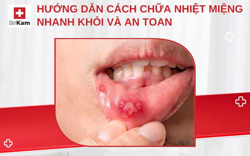 cach chua nhiet mieng nhanh khoi thumbnail