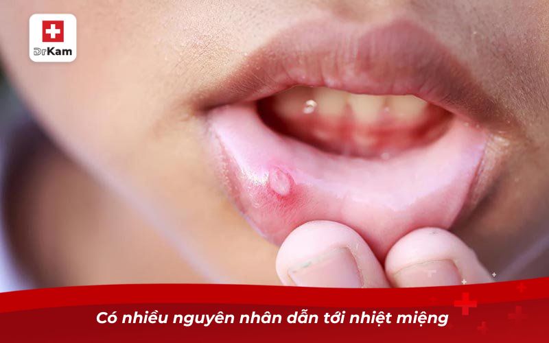 Có nhiều nguyên nhân dẫn tới nhiệt miệng 